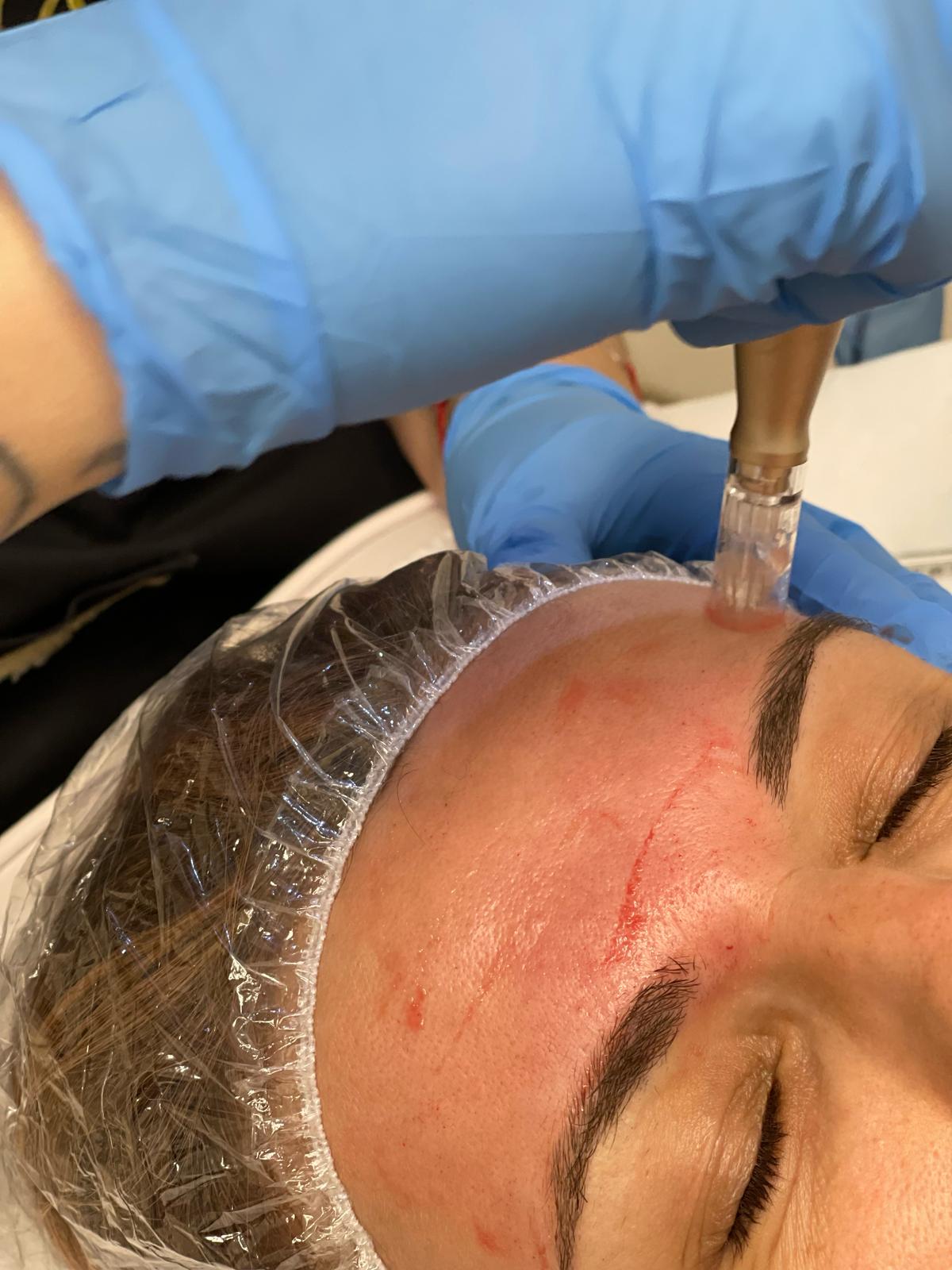 Microneedling